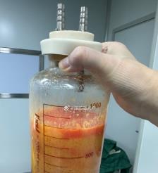 东营水动力吸脂手术要做多久？